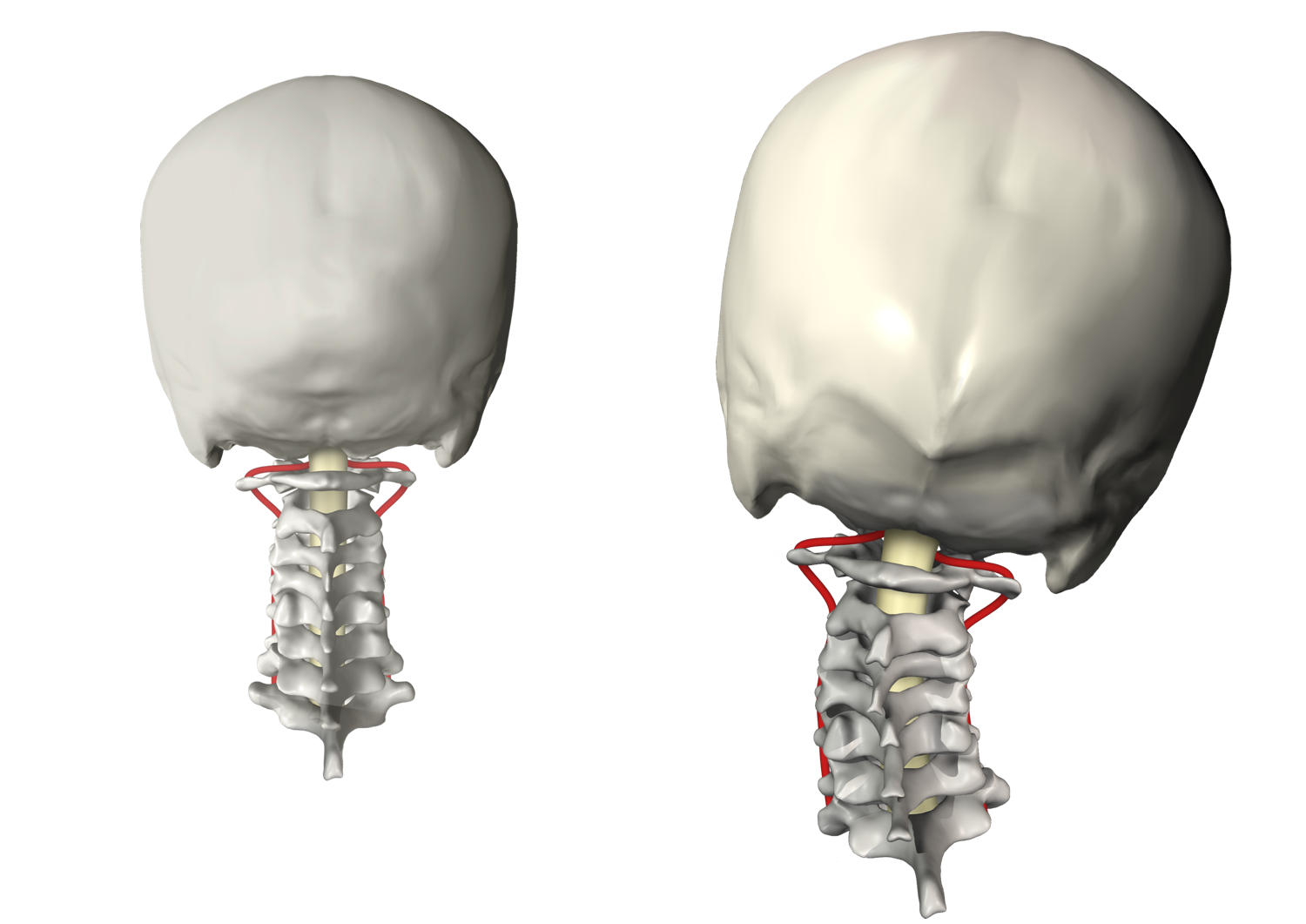 Normal versus Subluxated Cervical Spine 1500 width